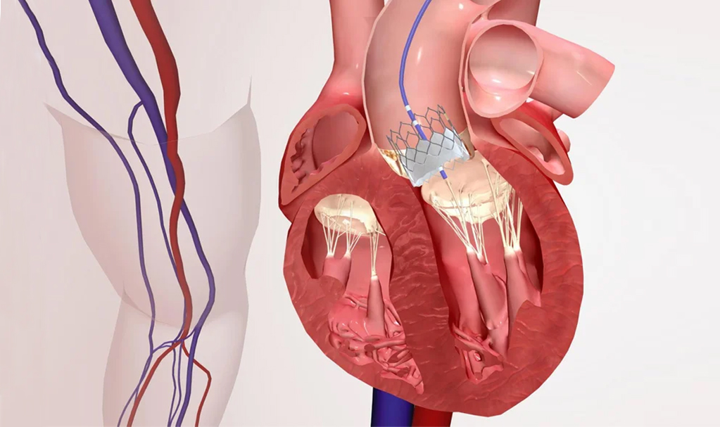 Balloon Mitral Valvoctony 2